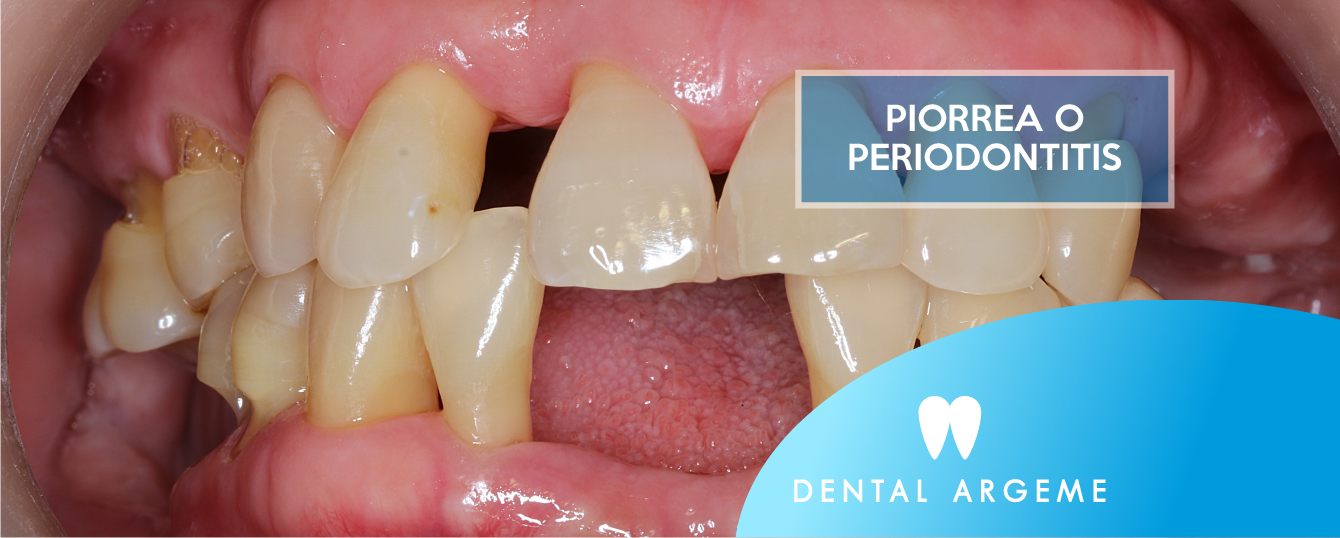 ¿SABES LO QUE ES LA PIORREA? ¿LA SUFRES? ¿SABES CÓMO TRATARLA